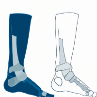 Ankle Fracture Surgery